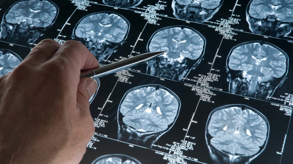 Google Trabaja en una IA que Acercar Respuestas Sobre el Alzheimer que Aún no Teníamos