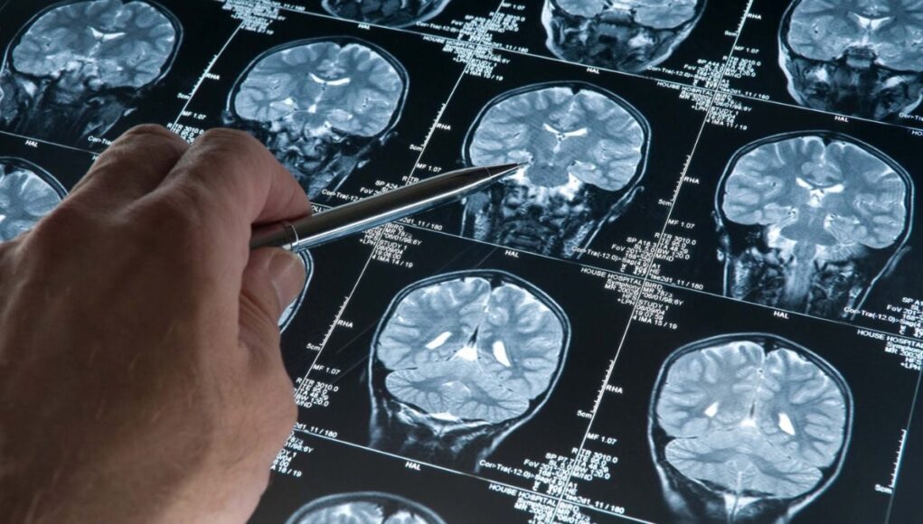 Google-Trabaja-en-una-IA-que-Acercar-Respuestas-Sobre-el-Alzheimer-que-Aun-no-Teniamos