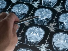 Google Trabaja en una IA que Acercar Respuestas Sobre el Alzheimer que Aún no Teníamos