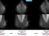 La Inteligencia Artificial Detecta Cáncer de Mama Hasta Seis Años Antes de que Aparezca La Inteligencia Artificial Detecta Cáncer de Mama Hasta Seis Años Antes de que Aparezca