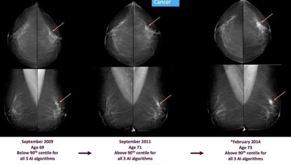 La Inteligencia Artificial Detecta Cáncer de Mama Hasta Seis Años Antes de que Aparezca La Inteligencia Artificial Detecta Cáncer de Mama Hasta Seis Años Antes de que Aparezca