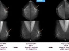 La Inteligencia Artificial Detecta Cáncer de Mama Hasta Seis Años Antes de que Aparezca La Inteligencia Artificial Detecta Cáncer de Mama Hasta Seis Años Antes de que Aparezca