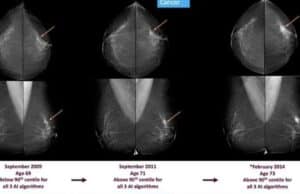 La Inteligencia Artificial Detecta Cáncer de Mama Hasta Seis Años Antes de que Aparezca La Inteligencia Artificial Detecta Cáncer de Mama Hasta Seis Años Antes de que Aparezca