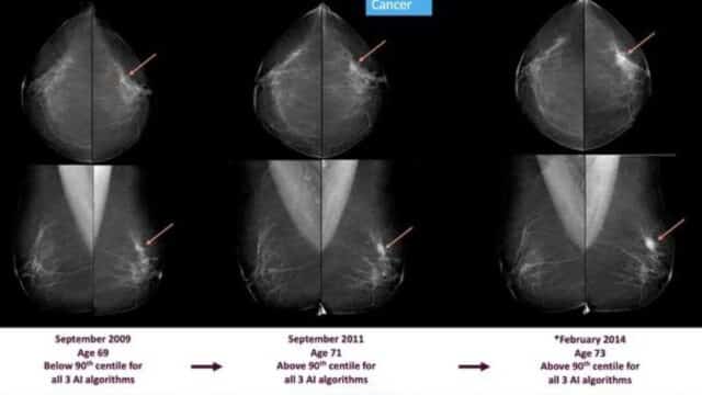 La Inteligencia Artificial Detecta Cáncer de Mama Hasta Seis Años Antes de que Aparezca La Inteligencia Artificial Detecta Cáncer de Mama Hasta Seis Años Antes de que Aparezca