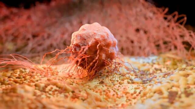 La IA de Plymouth Encuentra Señales del Cáncer de Vejiga Hasta Cinco Años Antes La IA de Plymouth Encuentra Señales del Cáncer de Vejiga Hasta Cinco Años Antes